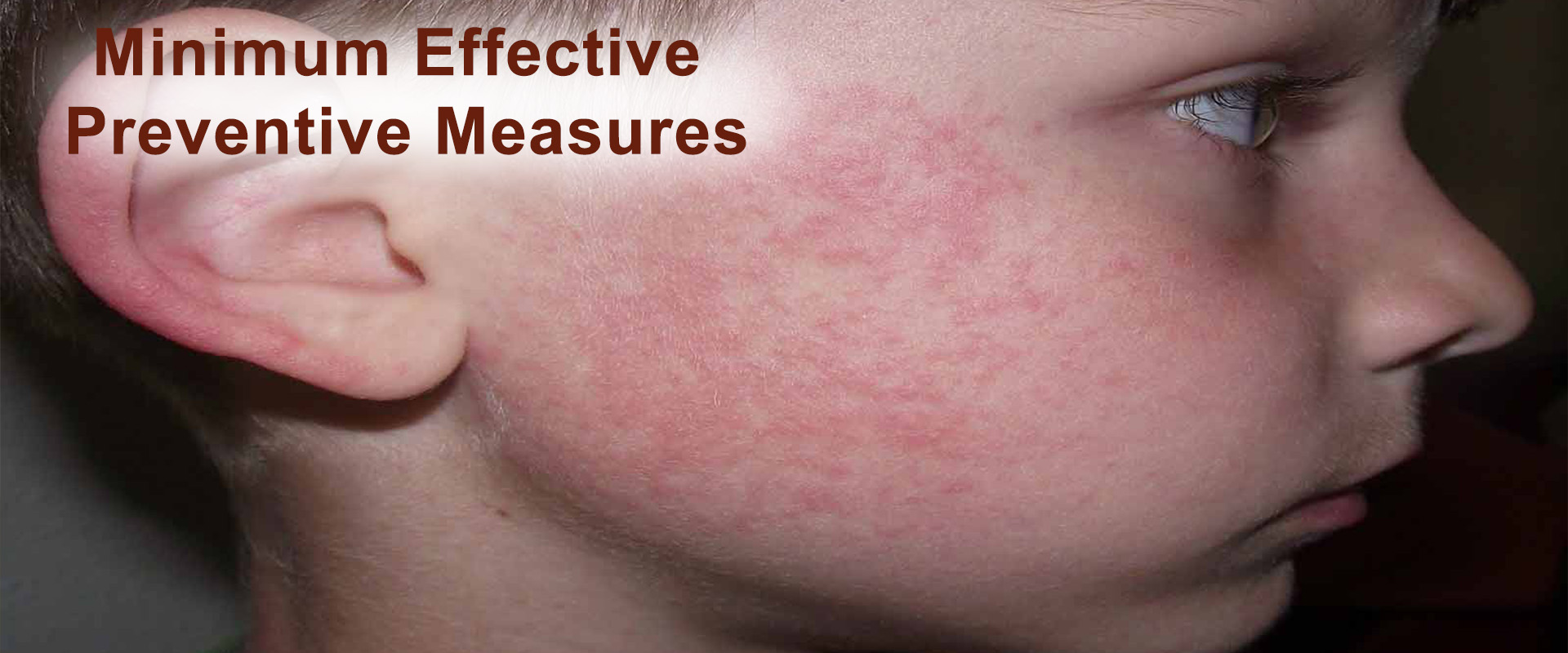 allergy-image-1
